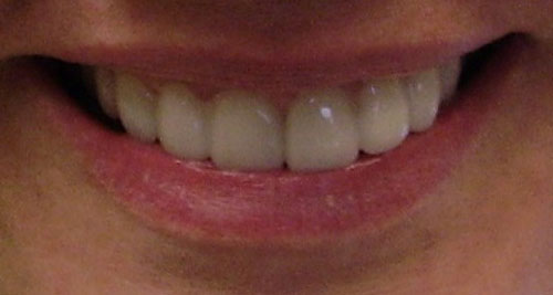 Patient smiling after getting brand new Lumineers® from Fairmount Dental Center in Salem, OR