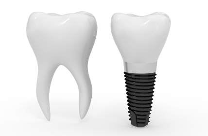 Dental implants diagram from Fairmount Dental Center in Salem, OR