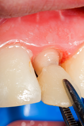 Our dentist placing a dental crown at Fairmount Dental Center in Salem, OR Our dentist placing a dental crown at Fairmount Dental Center in Salem, OR