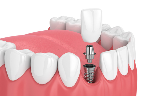 Rendering of jaw with dental implant at Fairmount Dental Center in Salem, OR.
