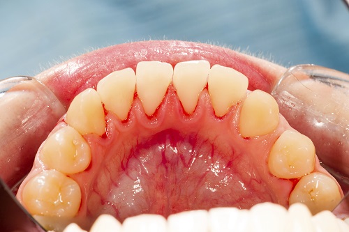 Close up of irritated bleeding gums from periodontal disease at Fairmount Dental Center in Salem, OR